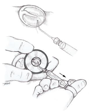 Illustration showing tympanocentesis with a needle