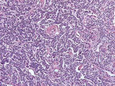 Granulosa cell tumor, gyriform pattern (hematoxyli