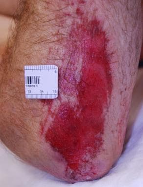 Abrasion on the elbow. 