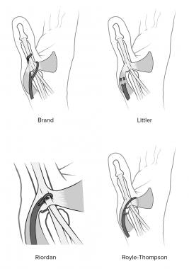 Techniques of distal attachment as described by Br