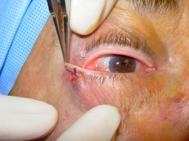 Lower-eyelid retractors and palpebral conjunctiva 