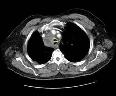 CT scan of chest in patient with tracheal stenosis