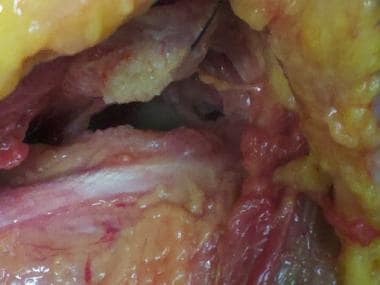 Inspection of the anterior shoulder and glenoid. 