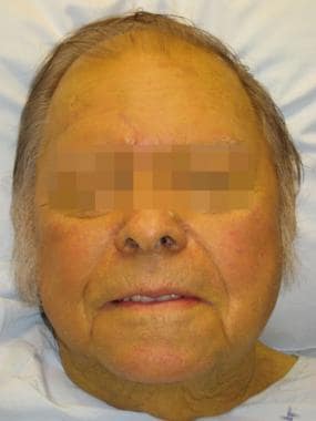 A person with jaundice due to hepatic failure. 