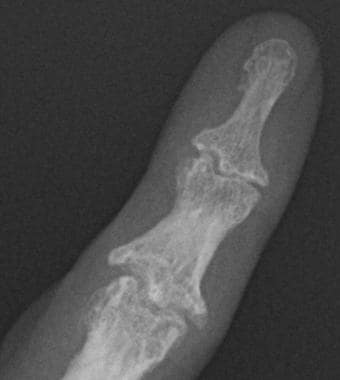 Close-up radiograph of the fifth digit shows osteo