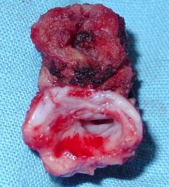 This photo shows a resected tracheal segment (same