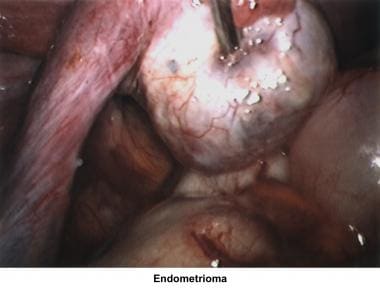 Infertility. Endometrioma. Image courtesy of Jairo