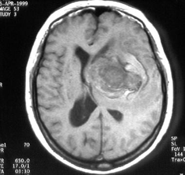T1-weighted magnetic resonance image (MRI) of a mi