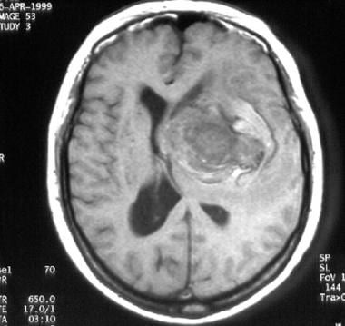 mi的t1加权磁共振成像(MRI)