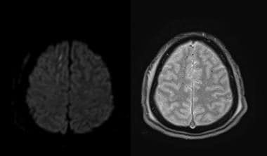 Diffusion-weighted axial image on the left demonst