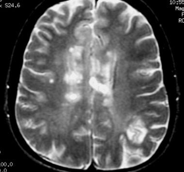 具有多个S的患者的轴向T2加权MRI