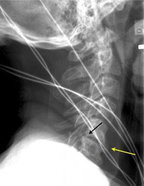 Lateral cervical spine radiographs may demonstrate