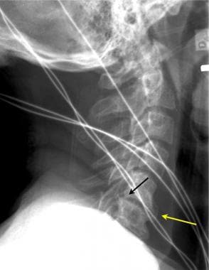 Spinal stenosis, Radiology Reference Article