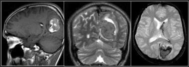 MR images show early subacute hematoma in the left