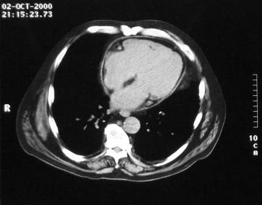 Slightly caudal image in this CT scan of the heart