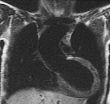Coronal T1-weighted MRI of the chest in a patient 