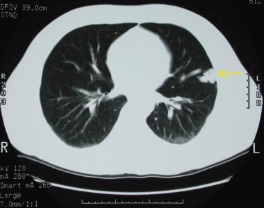 A pulmonary arteriovenous malformation in the left