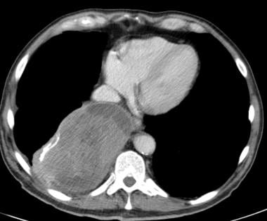 Axial CT scan in a 67-year-old man with a history 