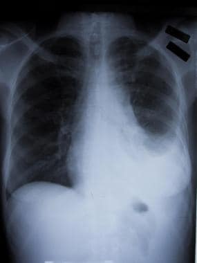Posteroanterior chest radiograph from a young fema