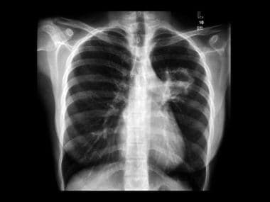A PA chest radiograph in a 28-year-old woman who p