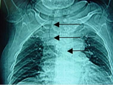 The chest radiograph shows an intrathoracic goiter