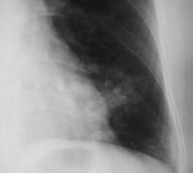 Solitary pulmonary nodule. Close-up view of a pulm