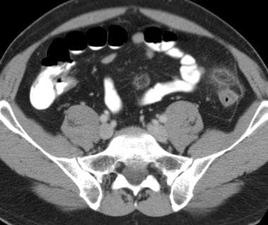 The CT image demonstrates a pericolic fat-attenuat