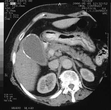 This CT scan obtained in a patient with nonbiliary