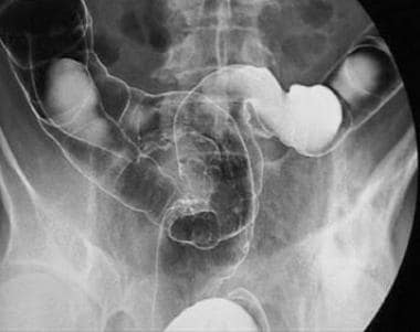 Polypoid carcinoma of the upper rectum. 