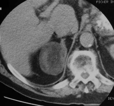 Unenhanced CT in an asymptomatic man reveals a 6-c