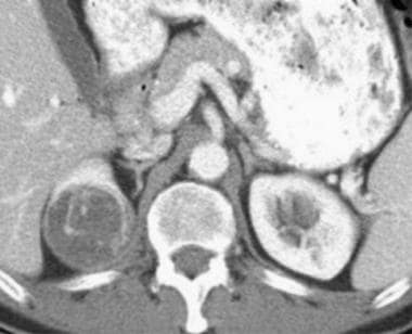 Case 8. Cystic renal cell carcinoma. Contrast-enha