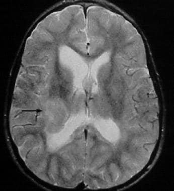 Axial T2-weighted MRI in a 46-year-old man demonst