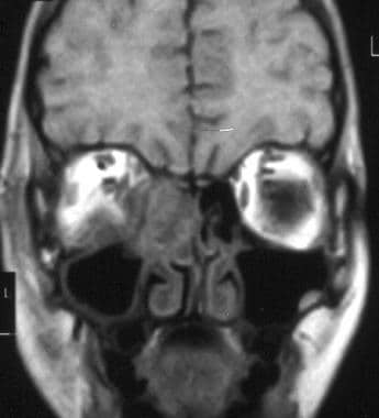 MRI shows intraorbital extension of ethmoid sinusi