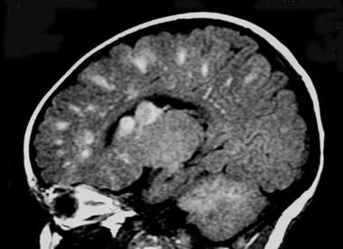 Sagittal T1-weighted MRI in an infant with tuberou