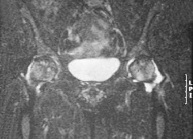 Coronal T2-weighted magnetic resonance image of th