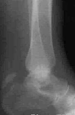 Calcaneus, fractures. Avulsion fracture. Rowe type
