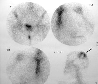 Radionuclide bone scans in a 28-year-old woman wit