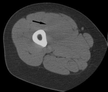 Computed tomography scan through the right thigh. 