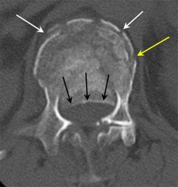 Lumbar spine trauma. Axial CT image in a patient w