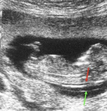 Normal nuchal translucency (red arrow) on a sagitt