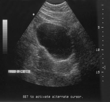 Sonogram shows a subserosal, 2.3- to 2.5-cm, right