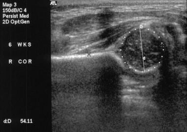 Real-time coronal sonogram of the hip with calcula