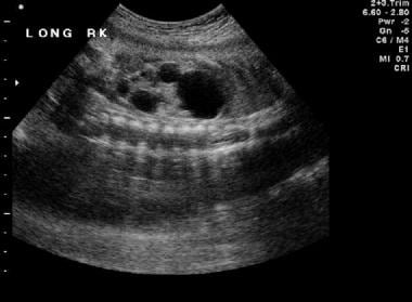 A prenatal sonogram shows the right multicystic dy