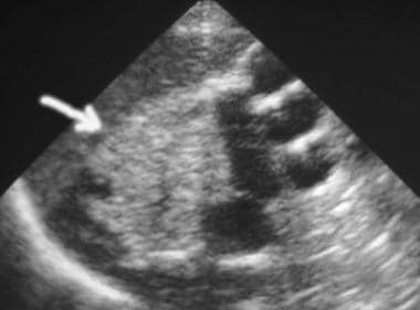Ultrasound examination of the kidneys shows bilate