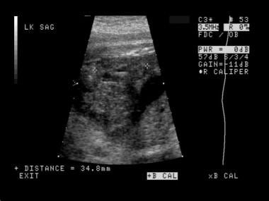 Prenatal longitudinal ultrasonogram of a normal le
