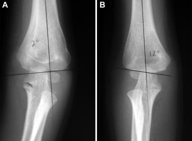 Baumann angle. A 5-year-old boy with previous left