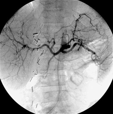 Case 1. Celiac arteriogram obtained in a patient w
