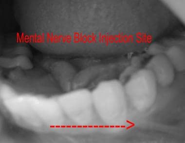 Mental nerve block injection site. 