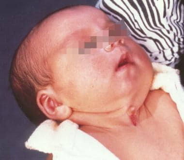 Three-week-old patient with congenital midline cer