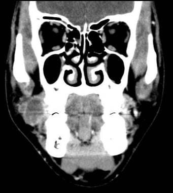 Coronal CT scan showing a 2x3 cm partially septate